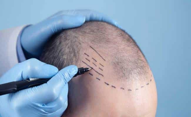 A guide to hair transplantation techniques