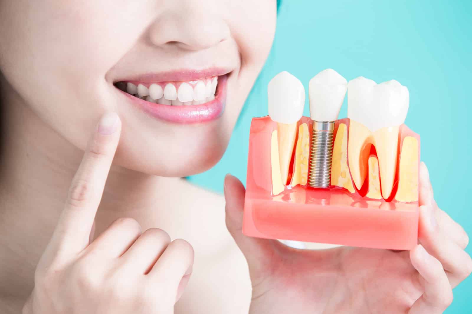 Dental Implants treatment