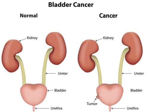 A Complete Guide on Bladder Cancer Treatment